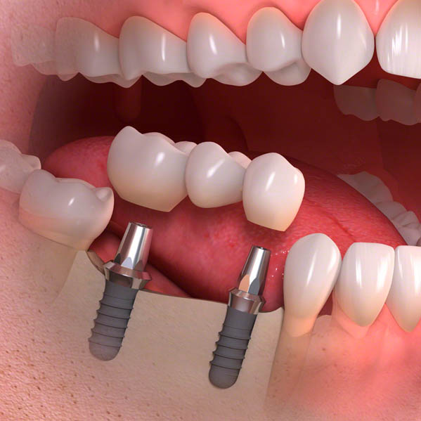 Implant borne multi tooth treatment 03