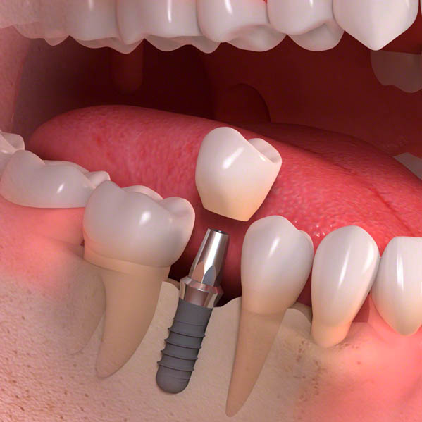 Implant borne single tooth treatment 03
